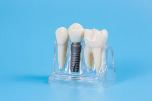 Cena implantu zęba Warszawa